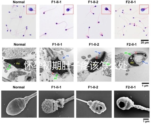 懷孕初期肚子疼該怎么處理