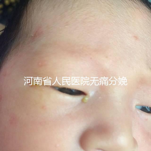 河南省人民醫院無痛分娩多少錢戳,收費標準60s看懂不踩坑